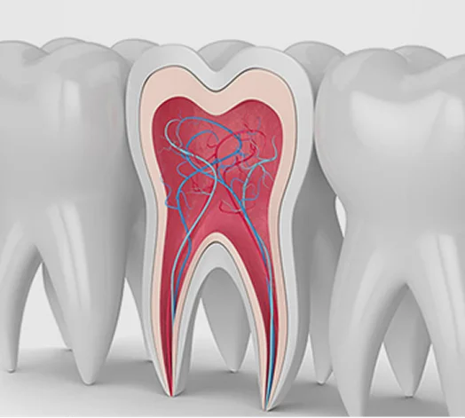 Retreatment of root canals