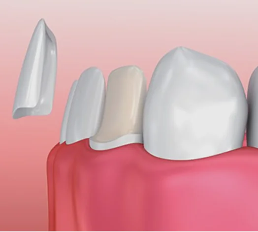Porcelain Veneers