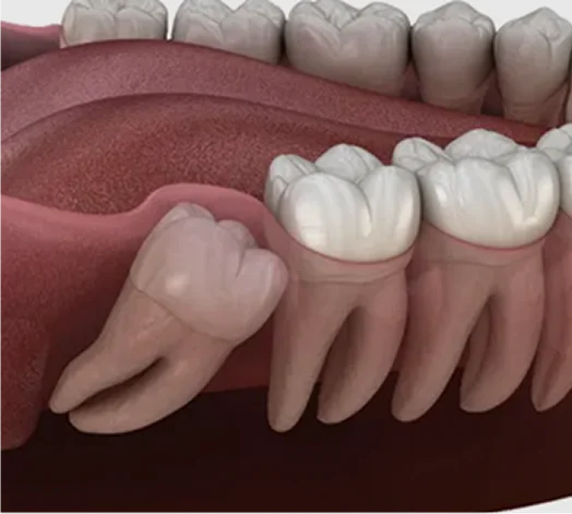 Wisdom Teeth Removal