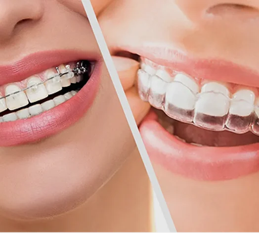  Invisalign® / Braces