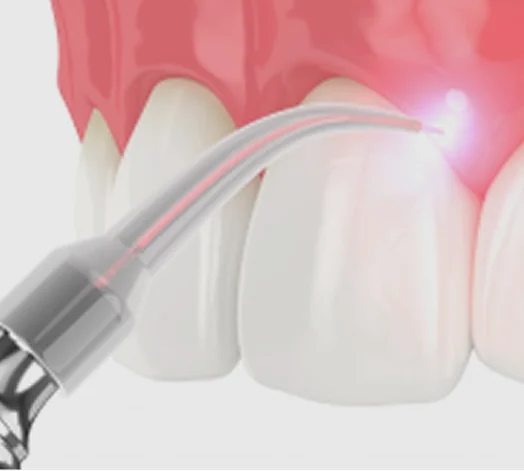 Deep Cleanings with Laser Bacterial Reduction